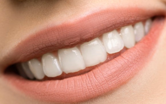 Teeth Whitening