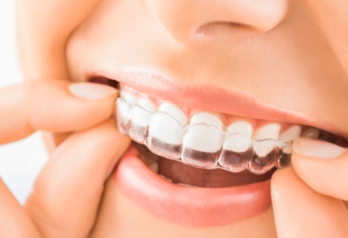 Invisible Aligners