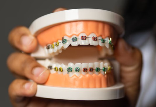 Braces