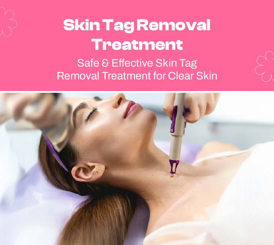 Skin Tags Stealing Your Confidence? Safe & Effective Removal
