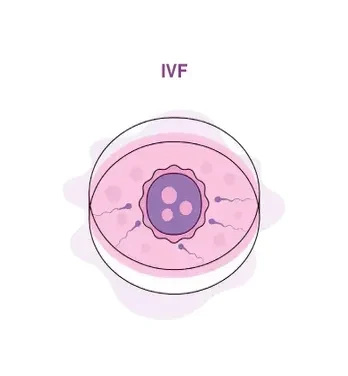 IVF