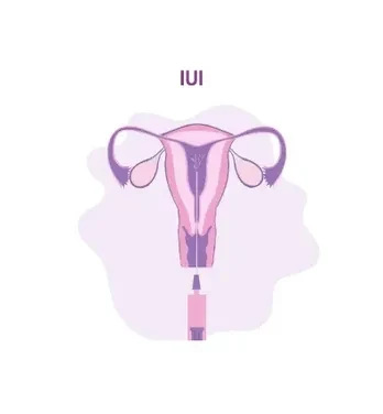 IUI