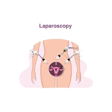 Laparoscopy