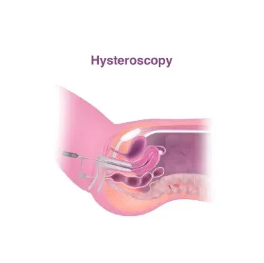 Hysteroscopy