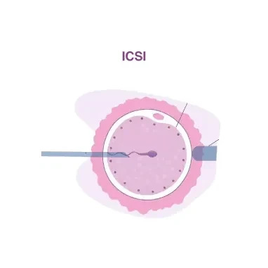 ICSI