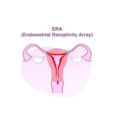 ERA (Endometrial Receptivity Array)