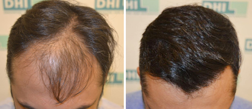 The Best Place to Get a Hair Transplant in India