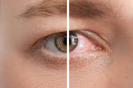 How to Cure Dry Eyes Permanently: Causes and Lasting Relief
