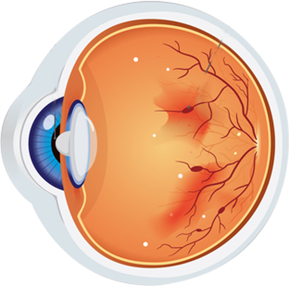 Diabetic Retinopathy Category