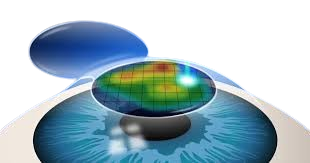 Contoura Lasik Category